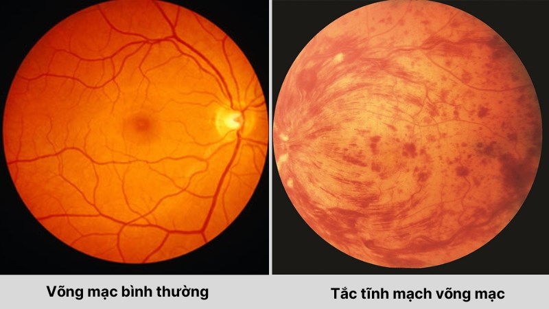 RVO xảy ra khi tĩnh mạch võng mạc bị tắc nghẽn một phần hoặc toàn bộ