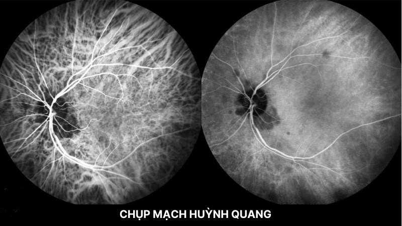 Chụp mạch huỳnh quang giúp khảo sát mức độ tắc nghẽn võng mạc