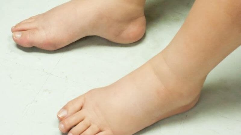 Bệnh thận bột gây nên tình trạng phù tay chân