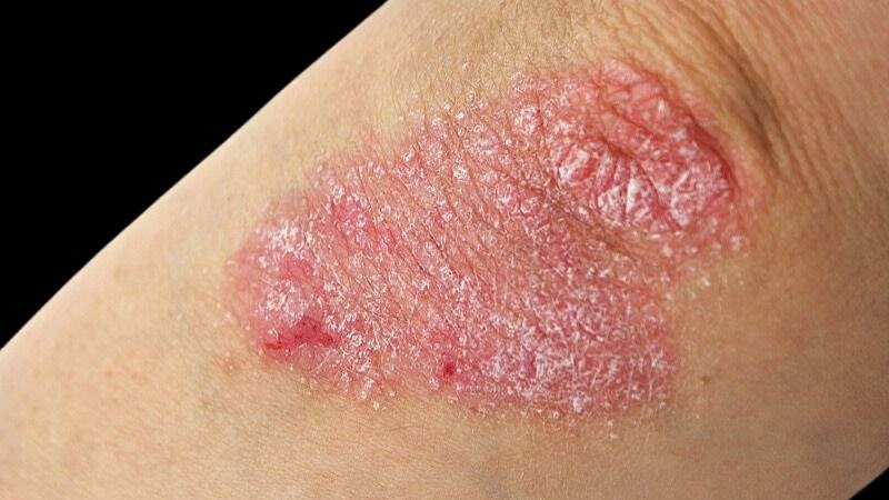 Vảy phấn đỏ nang lông là một bệnh da liễu mạn tính hiếm gặp