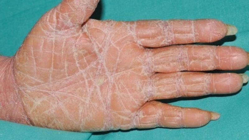 Bệnh vảy phấn hồng nang lông ở người lớn có thể hết trong 2 - 3 năm hoặc lâu hơn