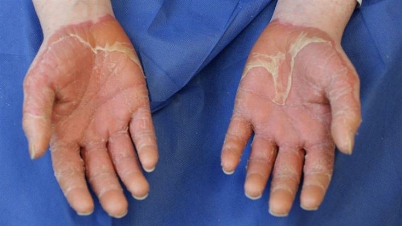 Da lòng bàn tay bị đỏ và dày sừng là dấu hiệu bệnh vảy phấn đỏ nang lông