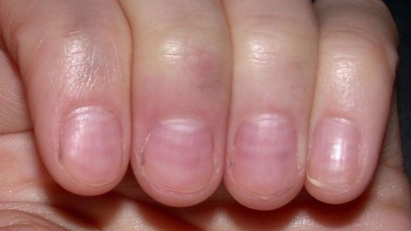 Nhiễm độc asen vài tháng sau khi tiếp xúc có thể xuất hiện đường Aldrich–Mee Nhiễm độc asen vài tháng sau khi tiếp xúc có thể xuất hiện đường Aldrich–Mee