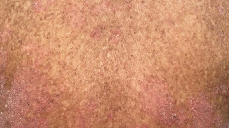 Nhiễm độc asen mạn tính có thể xuất hiện các nốt tăng sắc tố trên da Nhiễm độc asen mạn tính có thể xuất hiện các nốt tăng sắc tố trên da