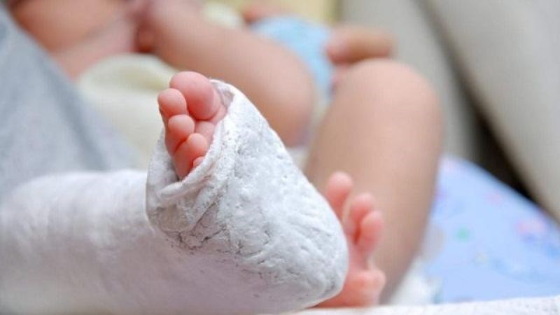 Bó bột là phương pháp thường sử dụng để điều trị chân khoèo 