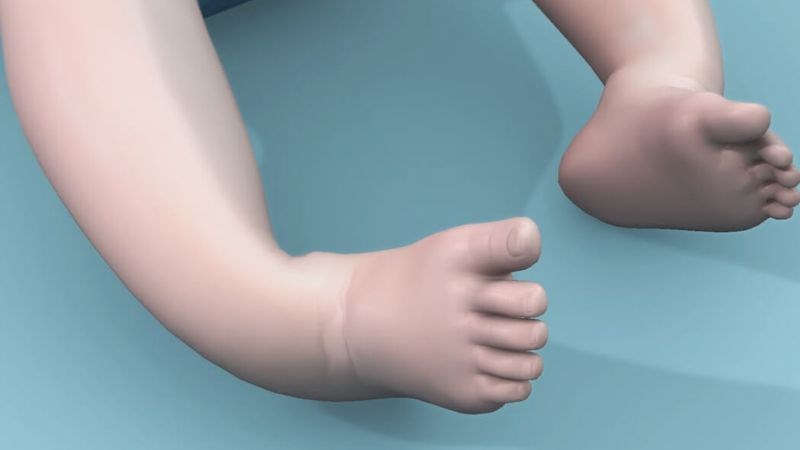 Bàn chân khoèo là tình trạng chân của trẻ quay vào trong