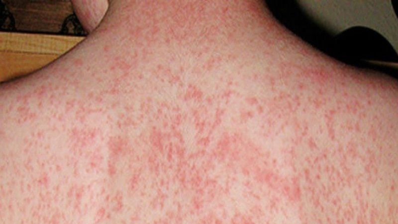 Phát ban da thường đi kèm sốt cao Phát ban da thường đi kèm sốt cao