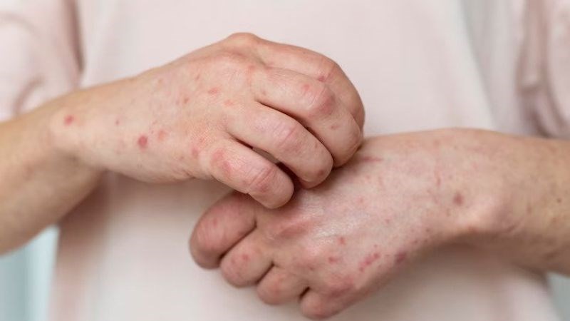 Bệnh Still ở người lớn ảnh hưởng đến nhiều cơ quan trong đó có da Bệnh Still ở người lớn ảnh hưởng đến nhiều cơ quan trong đó có da