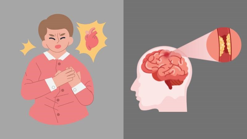 Đột tử xảy ra do tắc mạch máu nuôi tim trong khi đột quỵ do tắc mạch máu não