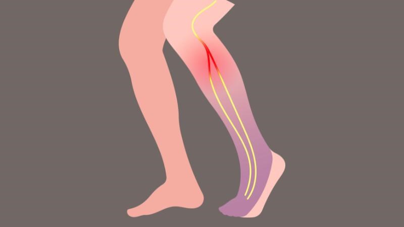 Tổn thương thần kinh mác gây tình trạng bàn chân rũ