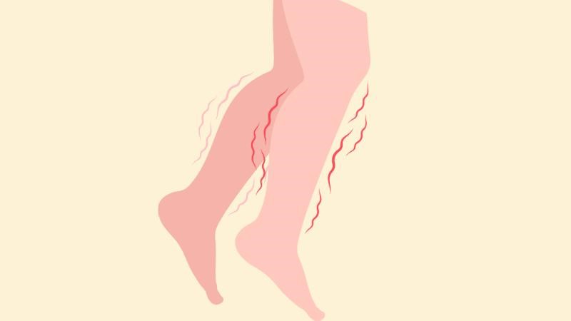 Dấu hiệu rũ bàn chân có thể đi kèm tê bì vùng chân, bàn chân