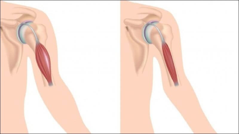 Loạn dưỡng cơ là bệnh lý di truyền hiếm gặp