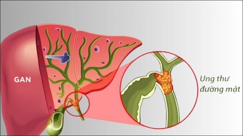 Ung thư đường mật trong gan là dạng ung thư phổ biến nhất
