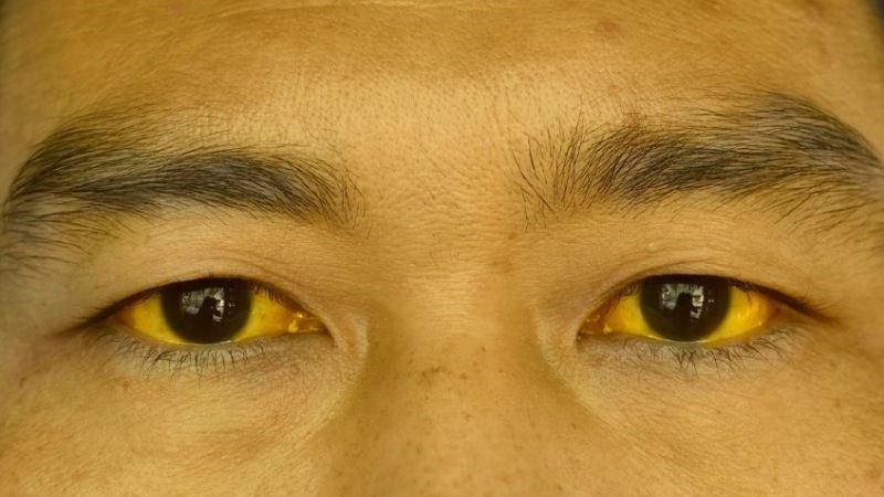 Vàng da và kết mạc mắt có thể là dấu hiệu của ung thư đường mật