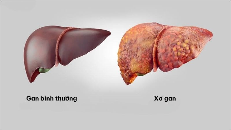 Ung thư đường mật gây ra biến chứng xơ gan khi có di căn trong gan
