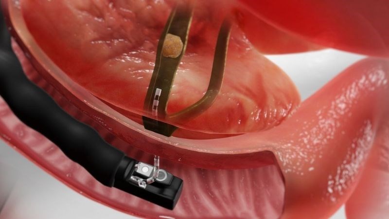 Nội soi mật tụy ngược dòng có thể giúp khảo sát bất thường tại đường mật