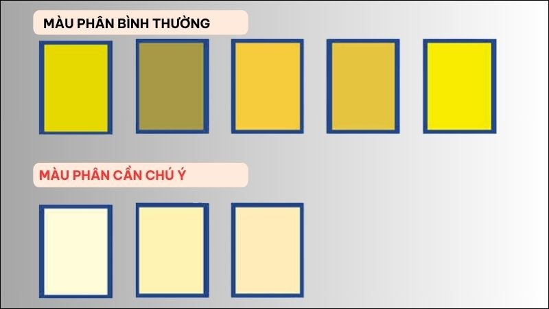 Phân bạc màu có thể là dấu hiệu cảnh báo bệnh lý gan mật