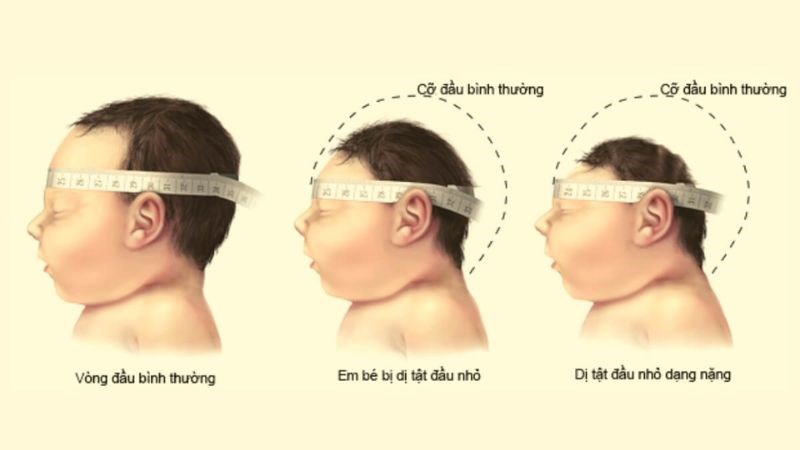 Vòng đầu nhỏ, chậm phát triển là một trong các dấu hiệu của giai đoạn 2 Vòng đầu nhỏ, chậm phát triển là một trong các dấu hiệu của giai đoạn 2