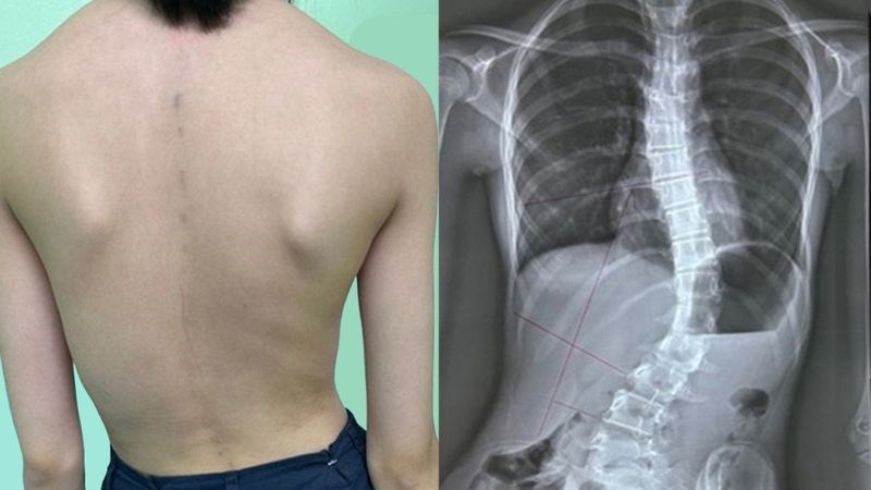 Cong vẹo cột sống là dấu hiệu muộn thường gặp trong giai đoạn 4 Cong vẹo cột sống là dấu hiệu muộn thường gặp trong giai đoạn 4