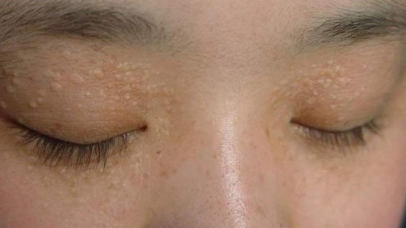 U ống tuyến mồ hôi thường xuất hiện ở mắt U ống tuyến mồ hôi thường xuất hiện ở mắt