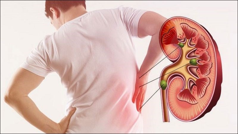 Nhiễm toan chuyển hóa có thể gây biến chứng sỏi thận