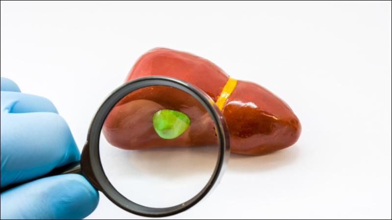 U cơ tuyến túi mật là một loại u lành tính của túi mật