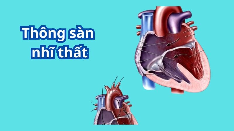 Thông sàn nhĩ thất là tình trạng cấu trúc tim bị rối loạn Thông sàn nhĩ thất là tình trạng cấu trúc tim bị rối loạn