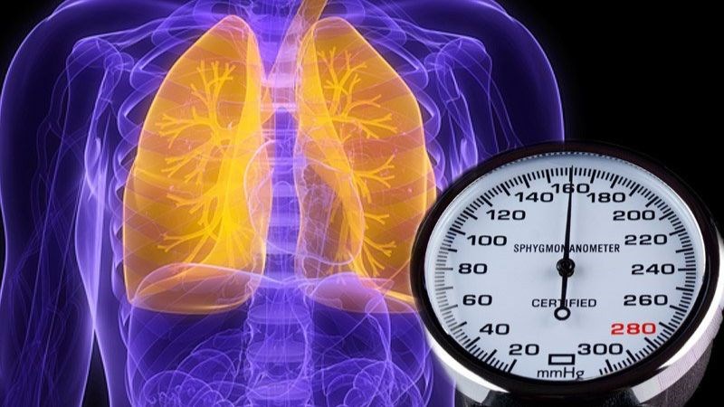 Tăng áp phổi là biến chứng thường gặp của thông sàn nhĩ thất Tăng áp phổi là biến chứng thường gặp của thông sàn nhĩ thất