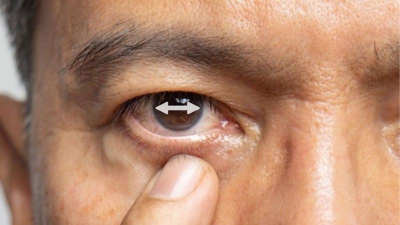 Rung giật nhãn cầu là tình trạng mắt chuyển động bất thường theo nhịp
