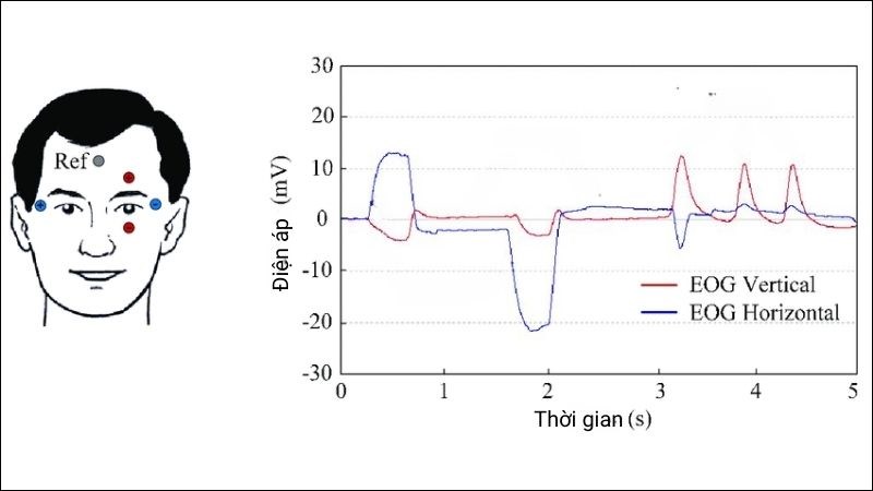 Điện nhãn đồ (EOG) giúp ghi lại chuyển động của mắt