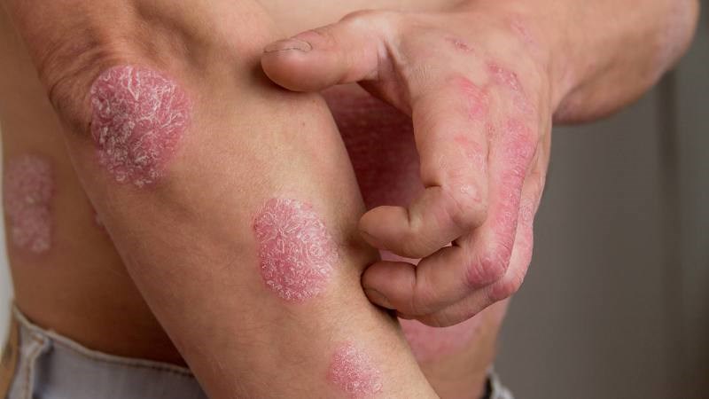 Bệnh chàm đồng tiền là một tình trạng viêm da mạn tính