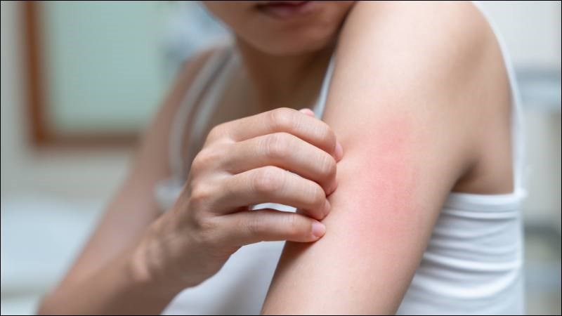 Chàm đồng tiền thường gây ngứa dữ dội