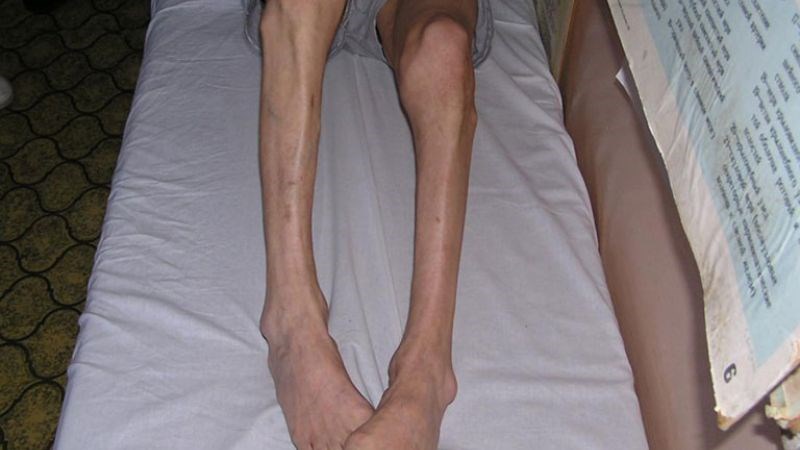 Teo cơ là tình trạng các mô cơ bị mất đi