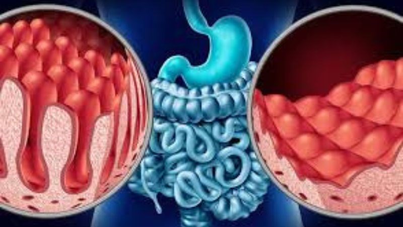 Bệnh Celiac có thể dẫn tới teo cơ