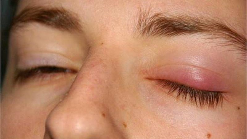 Người bị lẹo mắt có thể dẫn tới sụp mí mắt Người bị lẹo mắt có thể dẫn tới sụp mí mắt