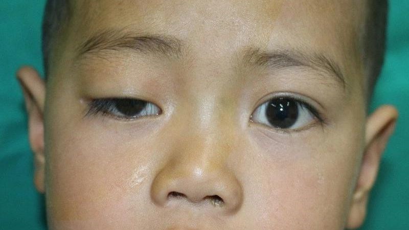 Sụp mí mắt có thể gây nhược thị Sụp mí mắt có thể gây nhược thị