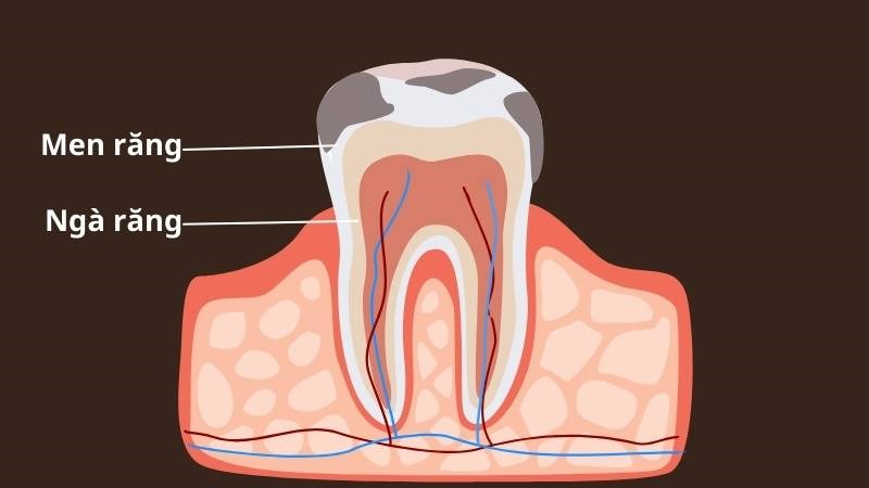 Răng ê buốt xuất hiện khi lớp ngà răng bên dưới bị lộ ra ngoài