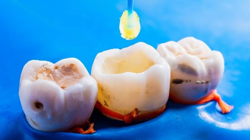 Nha sĩ sử dụng chất trám để che phủ chân răng và giảm ê buốt