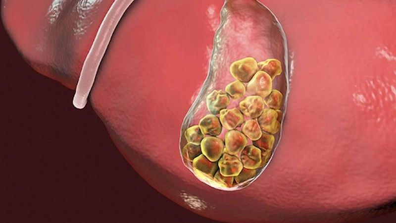 Sỏi mật có thể gây ra cơn đau bụng trên bên phải