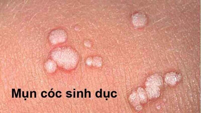 Mụn cóc sinh dục có hình dạng như súp lơ Mụn cóc sinh dục có hình dạng như súp lơ