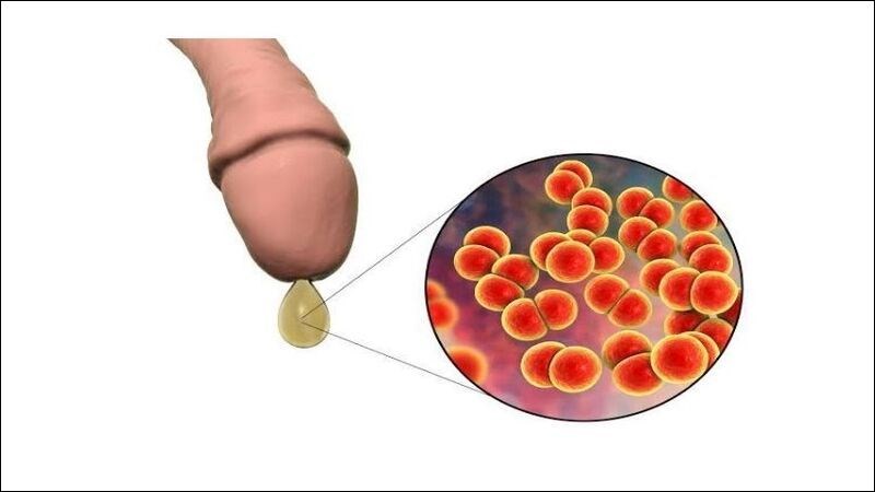 Ngứa dương vật có thể kèm theo tình trạng chảy mủ Ngứa dương vật có thể kèm theo tình trạng chảy mủ