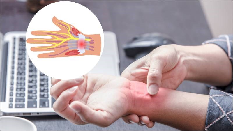 Hội chứng ống cổ tay xuất hiện do áp lực lên dây thần kinh giữa