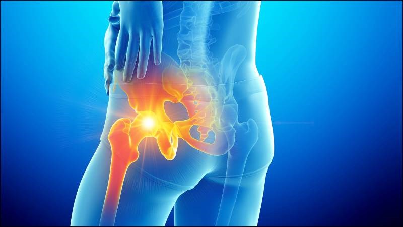 Viêm khớp là nguyên nhân gây đau hông thường gặp