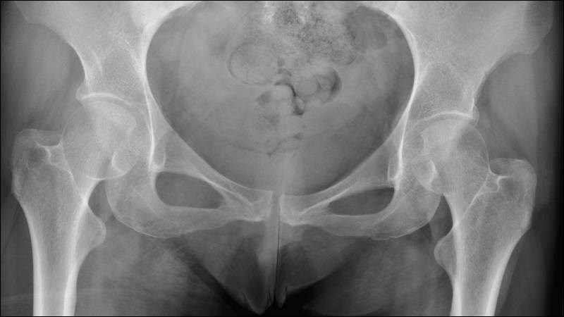 Hình ảnh X-quang hỗ trợ chẩn đoán tình trạng đau hông