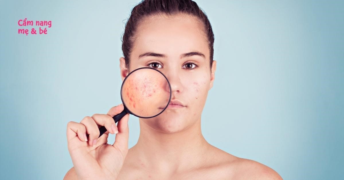 Có những sản phẩm chăm sóc da nào giúp làm giảm mụn ẩn và không cần nặn?