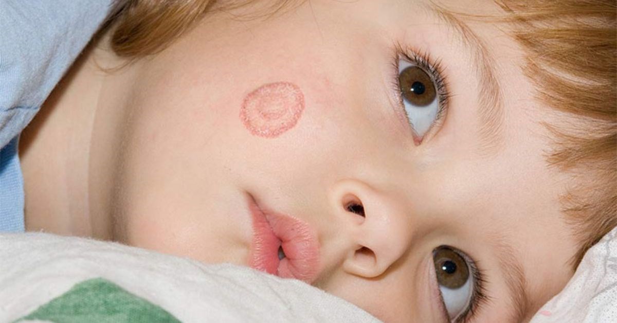 Làm thế nào để chẩn đoán bệnh nấm da ở trẻ sơ sinh?

