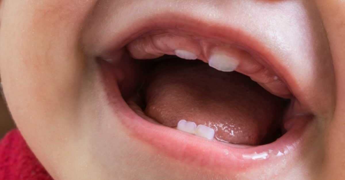 Răng sữa mọc lệch có thể tự khắc phục được không?
