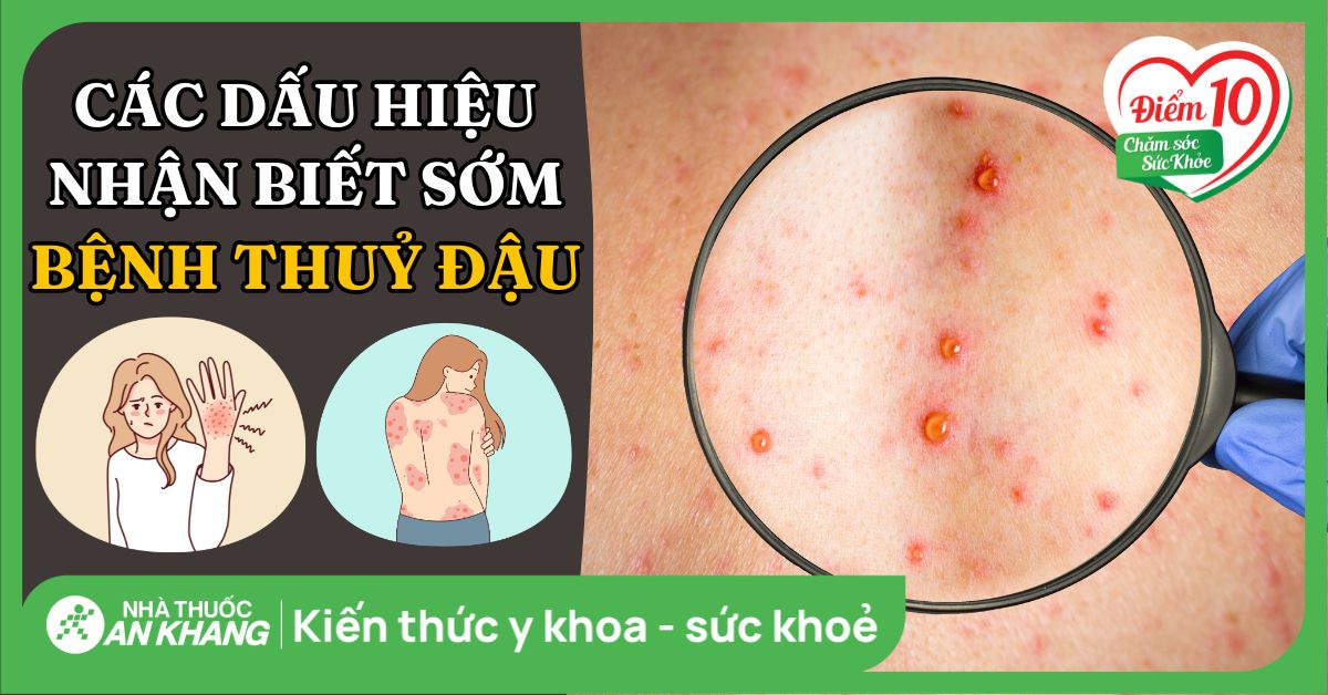 Cách điều trị và chăm sóc khi bị thủy đậu