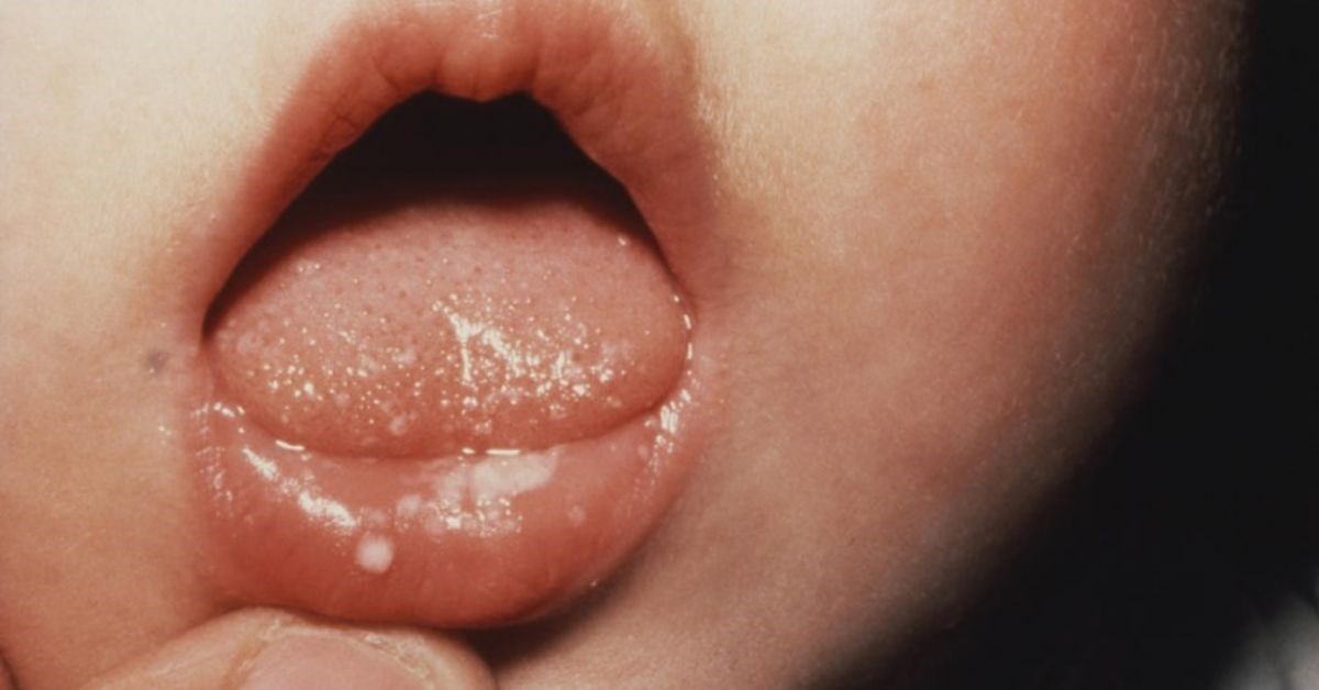 Có cách nào để giúp trẻ em 2 tuổi giảm ngứa và khó chịu khi bị nấm miệng?
