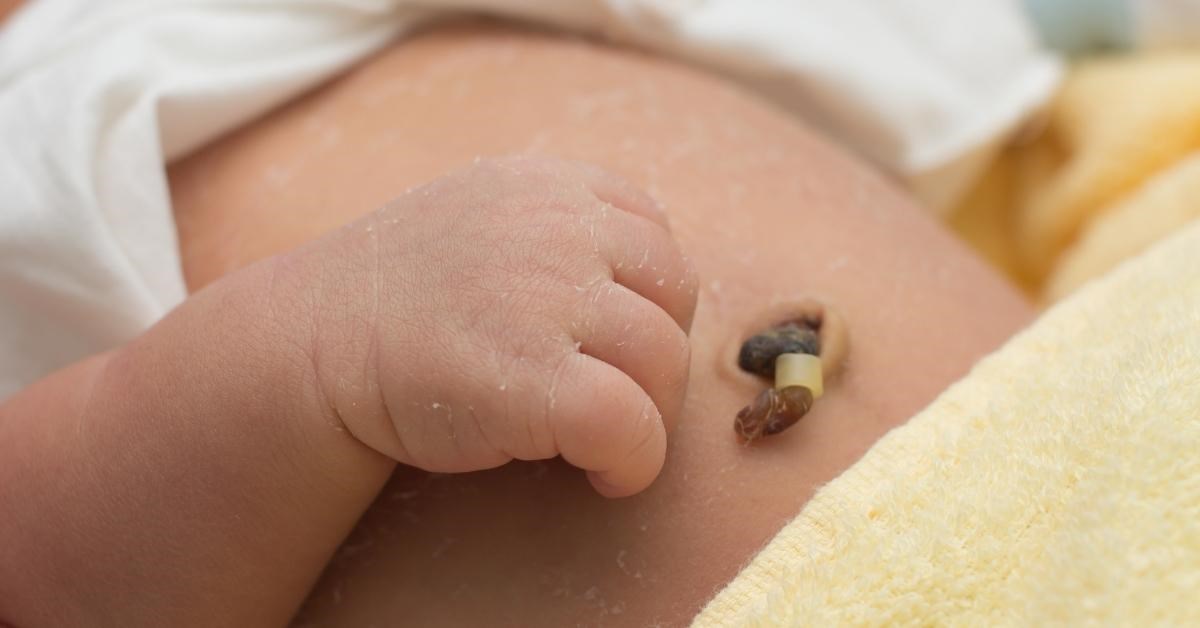 Điều trị nhiễm trùng rốn ở trẻ sơ sinh bao gồm những phương pháp nào?
